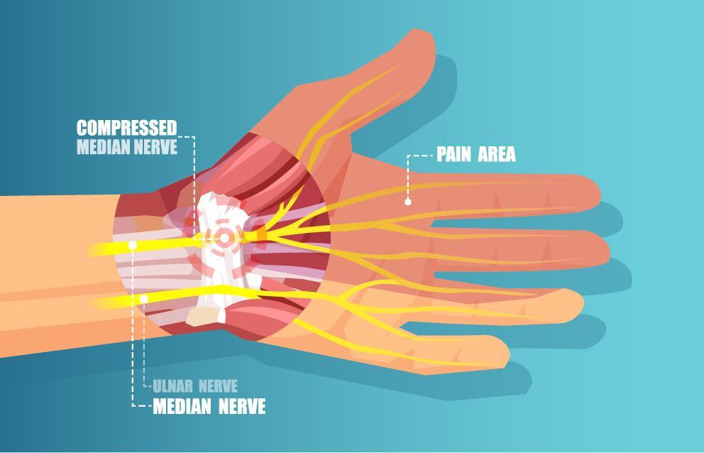 Carpal Tunnel Syndrome Illustration