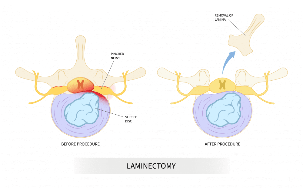 Laminectomy