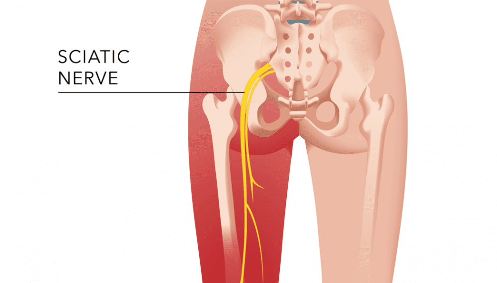 Pain from Sciatica