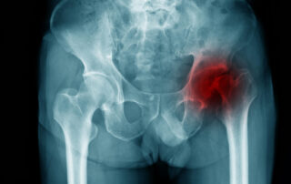 partial hip replacement